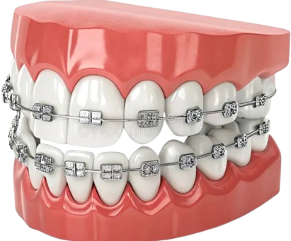 Braces and Aligners Ahmedabad