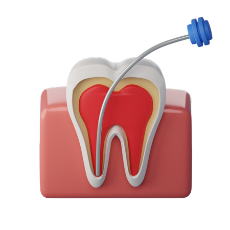 Root Canal Treatment Ahmedabad