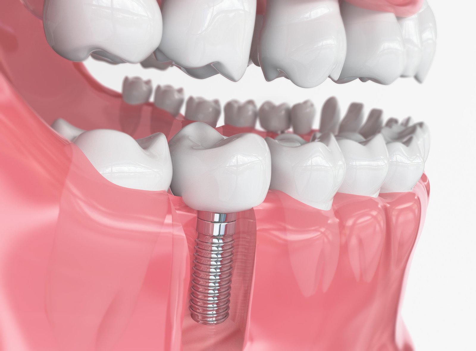 Dental Implants in Ahmedabad